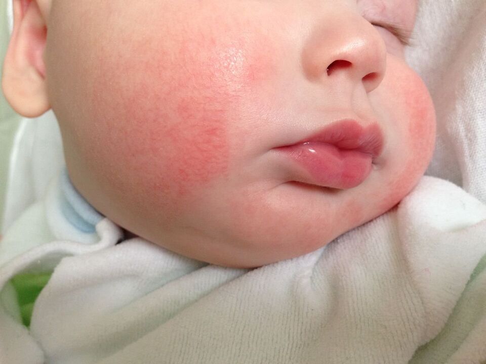 Tanda cacingan pada anak adalah urtikaria alergi